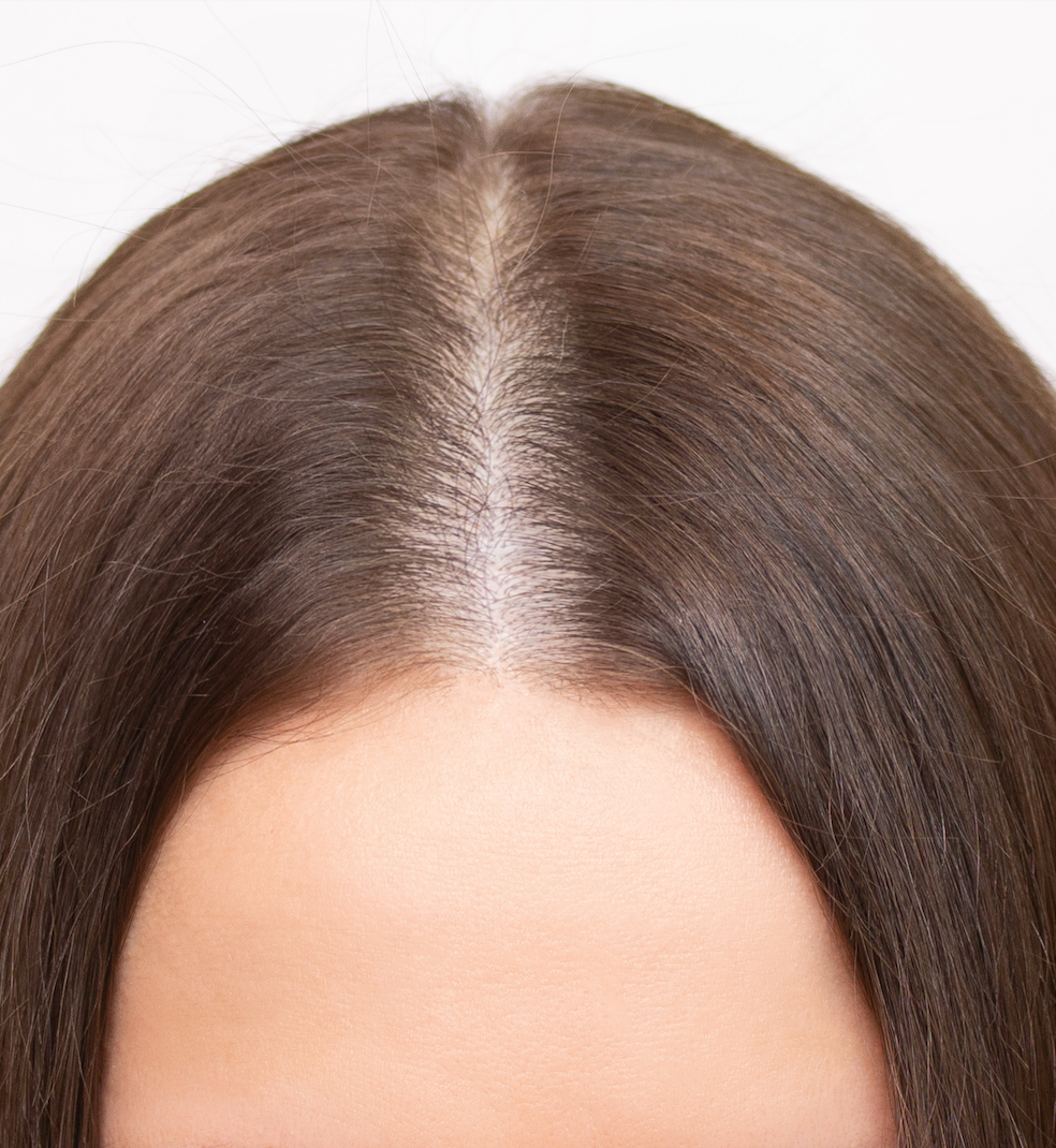 chute de cheveux femme perte de cheveux hormonale femme alopécie féminine diminution volume cheveux femme solution perte de cheveux femme